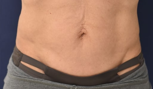 After TruSculpt ID Stomach
