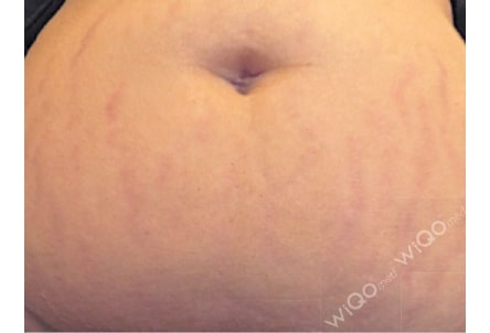 after stretch marks..