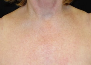 chemical peel After chest 1 300x213 1