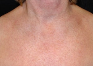 chemical peel before chest1. 300x213 1