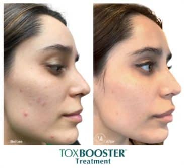 ToxBooster Treatment™ BA 3 1 e1635525958917